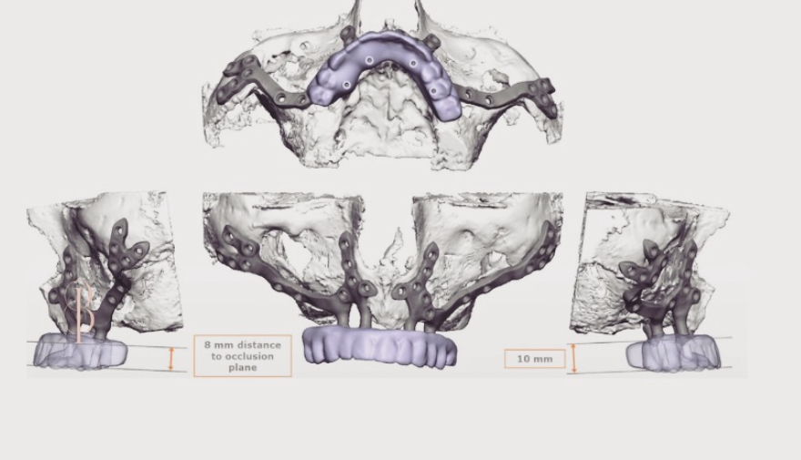 3D digital planning of patient-specific subperiosteal implants